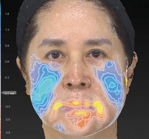 Анализ с VECTRA на обема при жена на 50 години
